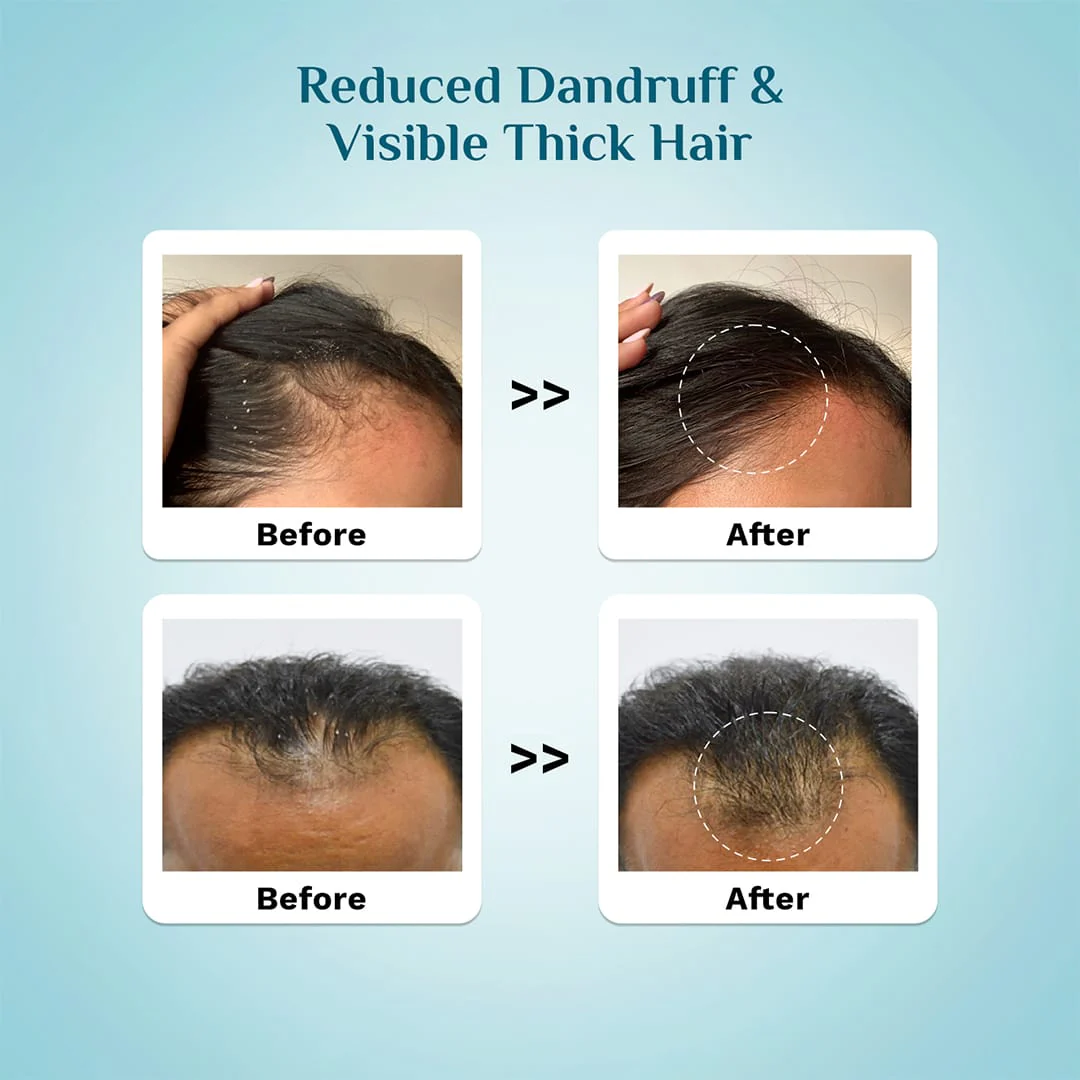3% Redensyl & 4% Anagain Advanced Hair Growth Serum For Dandruff-Prone Scalp - 30 ml - Image 4
