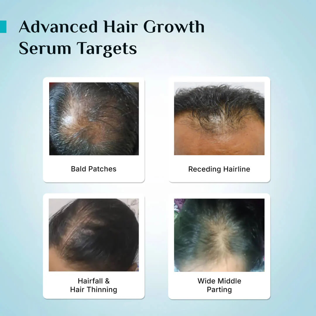 3% Redensyl, 4% Anagain & 5% Capilia Stem Cell Complex Advanced Hair Growth Serum - Image 34